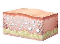 진피층 재생 시작